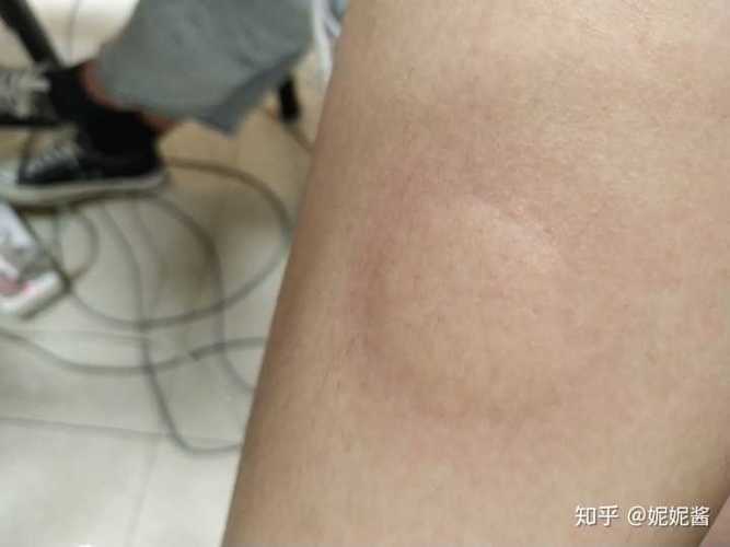 阿明给蚊子咬了一大一小的包，资源管理视角下的启示